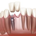 pros and cons of dental implants