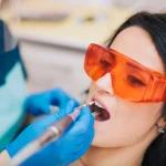 composite fillings