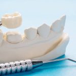 dental crown materials